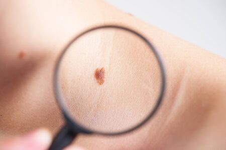 Investigation of moles on the body, diagnosis of skin diseasesの写真素材