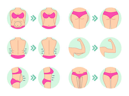 Liposuction. Liposuction hips, stomach. Removal of fat. Plastic surgery. Stock vector.のイラスト素材