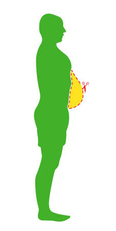 Weight loss concept. Before and after diet and fitness. Body with different weight. Healthy lifestyle.のイラスト素材