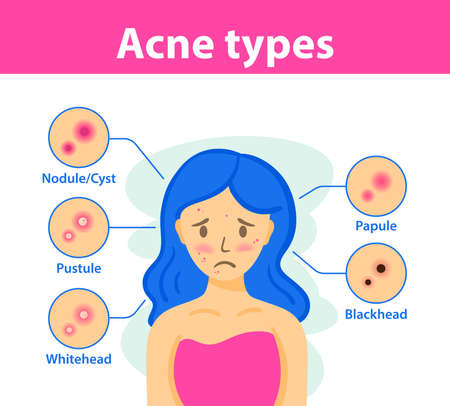 Types of acne, causes of the disease, treatment. Infographics of acne.のイラスト素材