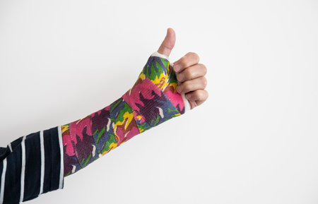 broken arm in cast but thumb upの写真素材