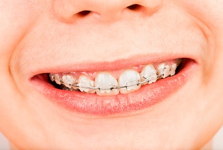 Smile with braces, boy ...