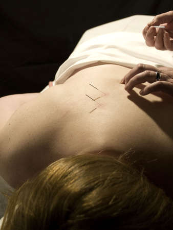 The Eastern or Asian acupuncture medical treatment said to prevent or treat a variety of medical ailments, including pain.の写真素材