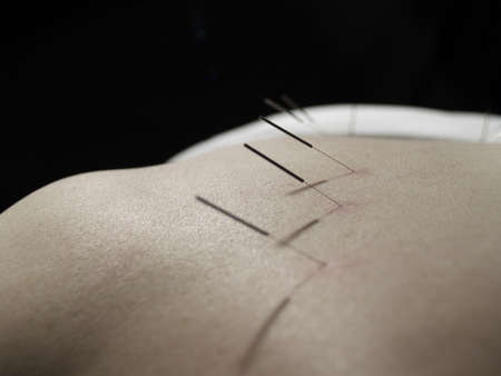 The Eastern or Asian acupuncture medical treatment said to prevent or treat a variety of medical ailments, including pain.の写真素材