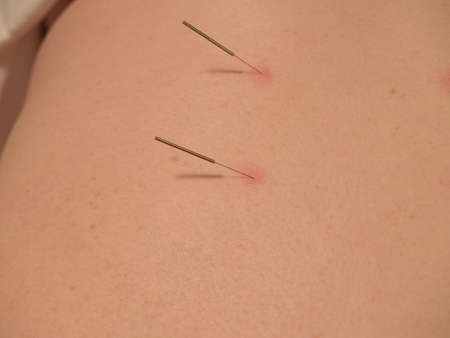 The Eastern or Asian acupuncture medical treatment said to prevent or treat a variety of medical ailments, including pain.の写真素材