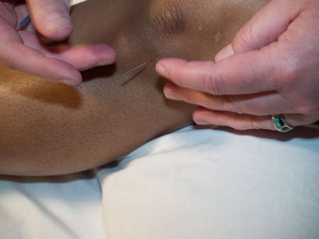 The Eastern or Asian acupuncture medical treatment said to prevent or treat a variety of medical ailments, including pain.の写真素材