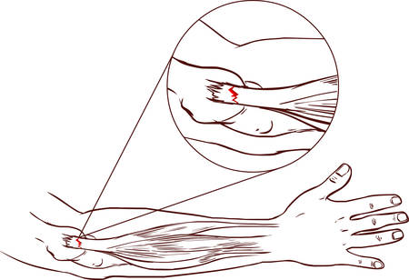 Tennis elbow - tear in the common extensor tendon of the arm (black and white)のイラスト素材