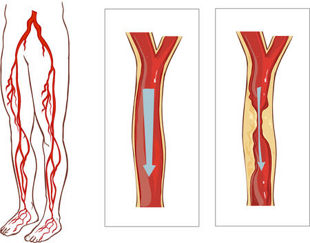 Vector illustration of aVascular System Legs. Atherosclerosis in arteryのイラスト素材