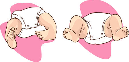 Newborn with bilateral club foot, also called congenital talipes equinovarusのイラスト素材