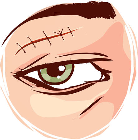 Vector - Illustration of a receiving first aid, injury or cut and sutured faceのイラスト素材