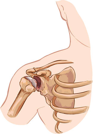 white background vector illustration of a shoulder dislocationのイラスト素材