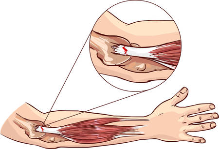 Tennis elbow - tear in the common extensor tendon of the armのイラスト素材
