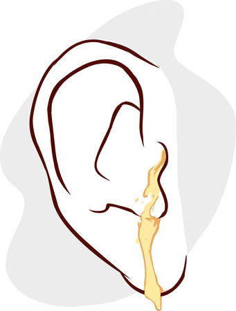 blue background vector illustration of a ear infectionのイラスト素材