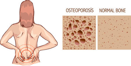 Osteoporosis, human bone anatomy. Medical illustration healthy bone and unhealthy boneのイラスト素材