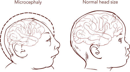 Illustration of a newborn baby with Microcephaly disease caused by Zika virusのイラスト素材