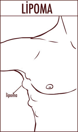 vector illustration of a lipoma.のイラスト素材