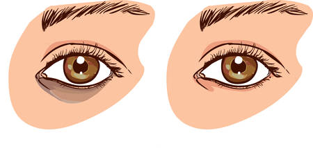 The woman's face with dark circles under the eyes. The concept of care for eye skin. before and afterのイラスト素材
