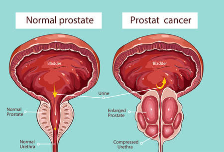 Vector - Prostatic hypertrophyのイラスト素材