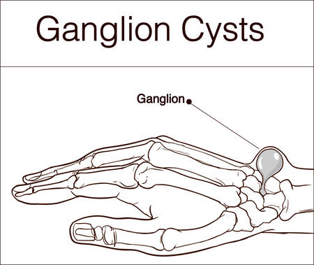 vector illustration of a Ganglion cystのイラスト素材