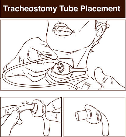 vector illustration of a tracheostomy tube placementのイラスト素材