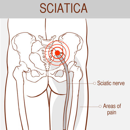 Medical illustration of symptoms of sciatica.のイラスト素材