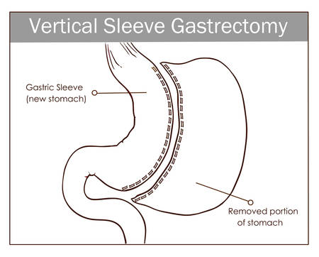 Vector illustration of Vertical Sleeve Gastrectomyのイラスト素材