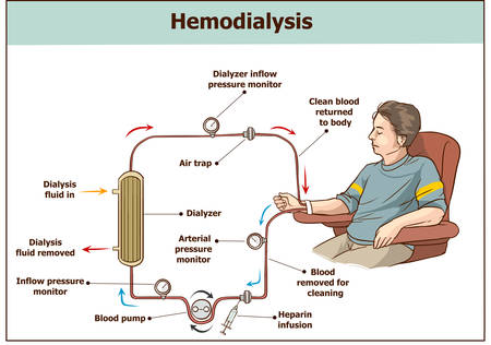 Hemodialysis procedure. Used for the renal insufficiency.のイラスト素材