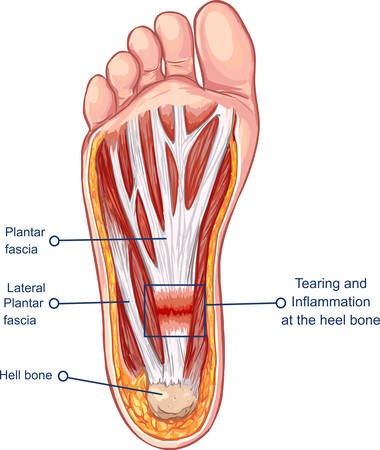  Vector  illustration of a Plantar Fasciitisのイラスト素材