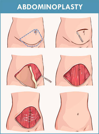 Vector illustration of a abdominoplasty and Lipectomy Proceduresのイラスト素材
