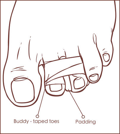 vector illustration of a Toe Buddy Tapingのイラスト素材