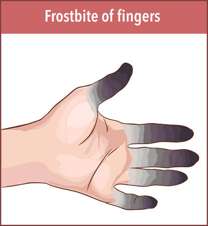 Vector illustration of a frostbite fingerのイラスト素材