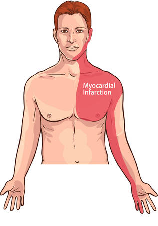 Vector illustration of a Heart attack pain location (Myocardial Infarction)のイラスト素材