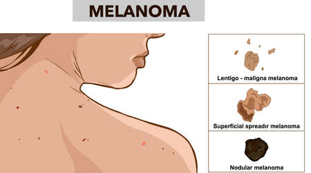 Three types of melanoma vector imageのイラスト素材