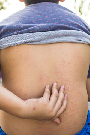 rash on back from allergy , the boy use finger scratch backの写真素材