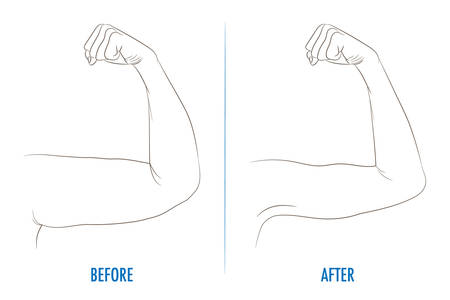 Female biceps before and after sport. Arms showing progress after fitness. Bent arm with bat wing vs well toned arm. Contour vector illustration for beauty, cosmetology, sport or medicine infographic.のイラスト素材