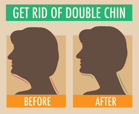 Reduce double chin. Get rid of face and neck fat concept illustration for beauty or plastic surgery infographic, before and after. Silhouettes of female head, side view. Fat and slim jaw line.のイラスト素材
