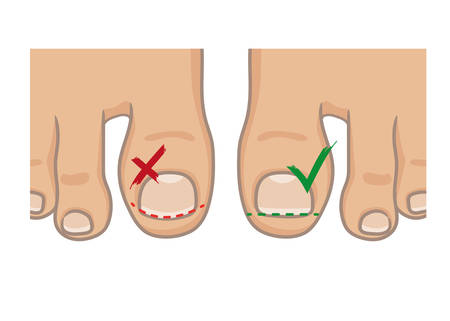 How to cut toenails, right and wrong concept. How to avoide ingrown nail. Female or male foot sole, barefoot, top view. Vector illustration, hand drawn cartoon style isolated on white.のイラスト素材