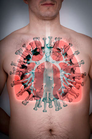 Coronavirus disease COVID-19 virus infection in human lungsの写真素材