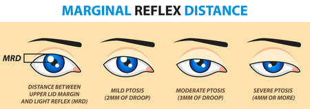 Marginal reflex distance. Vector illustration.のイラスト素材