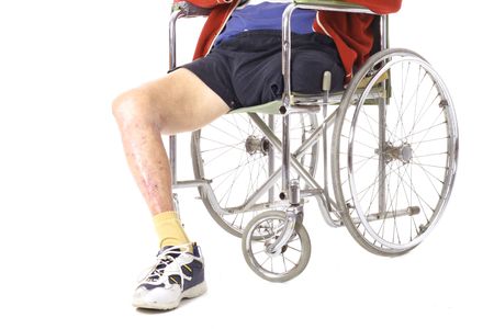 after surgery leg amputationの写真素材