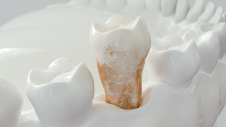 strong plaque on a molar tooth -- 3D Renderingの写真素材