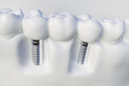 Tooth human implant - 3D Renderingの写真素材