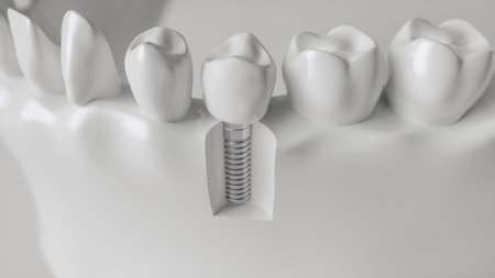 An implant in the jaw - 3d rendering