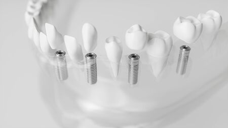 Several implants in a glassy jaw - 3d renderingの写真素材