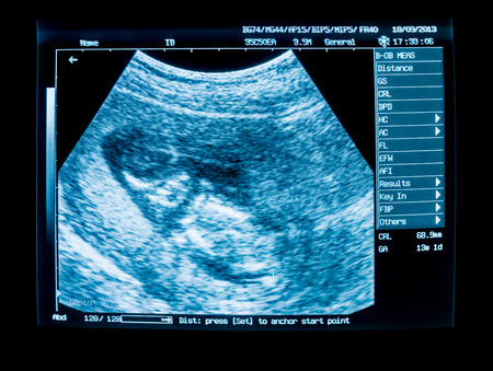 Pregnancy ultrasound for the fetus image from equipment monitorの写真素材