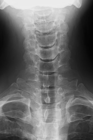 X-ray image of cervical vertebrae, frontal view