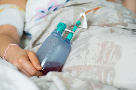 Woman hold a surgical drainage while in bed after surgeryの写真素材