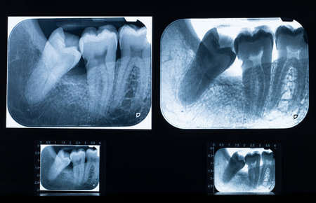 Detailed X-ray scan with impacted wisdom teeth issueの写真素材