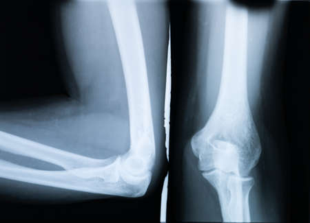 X-ray with the elbow wrists of a woman with osteoarthritisの写真素材