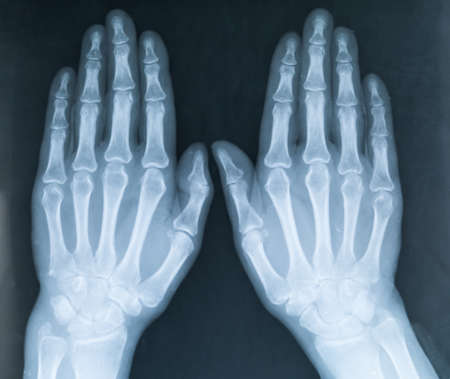 X-ray of two human hands. X-ray image of the hands of a senior woman with Osteoarthritisの写真素材